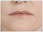 Botox and Dermal Fillers wrinkle removal at Kingswood Clinic in Blackburn 378608 Image 2